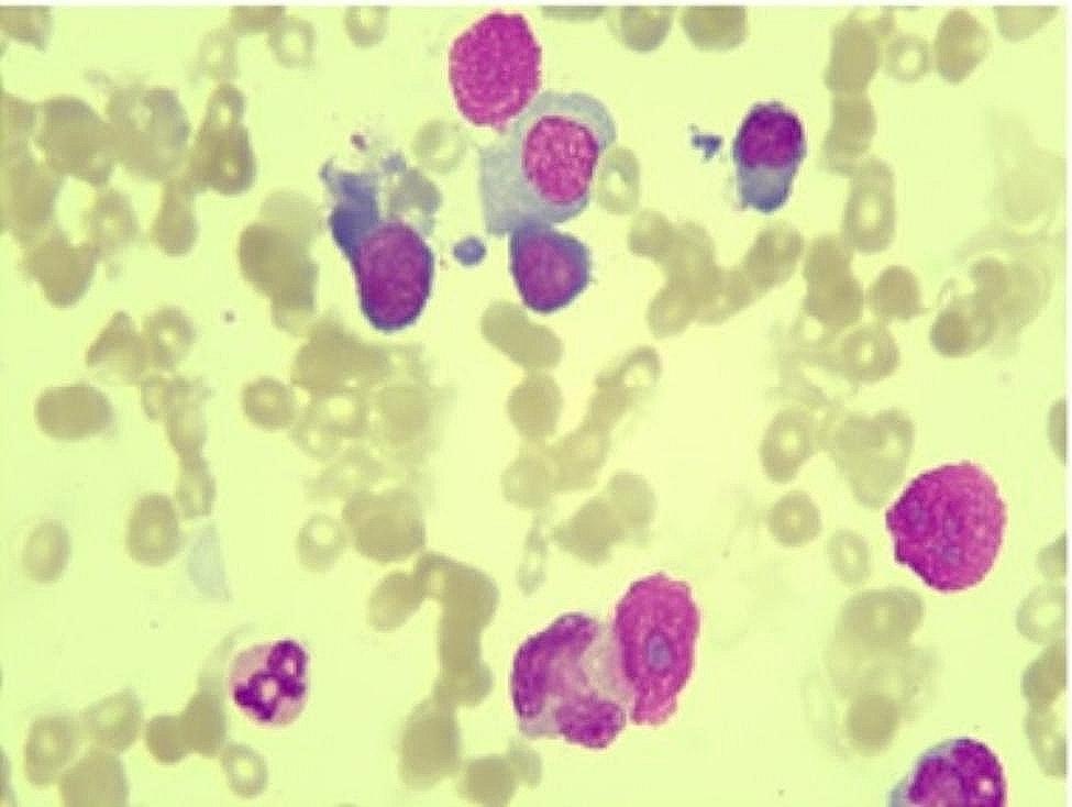 Severe megaloblastic anemia in a patient with advanced lung