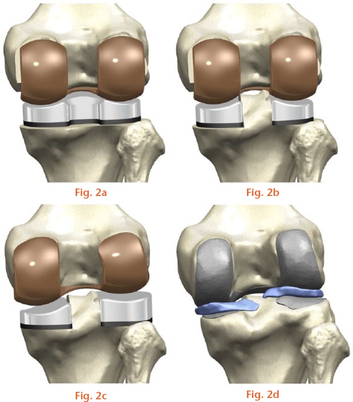 graphic file with name bonejointres-06-557-g002.jpg