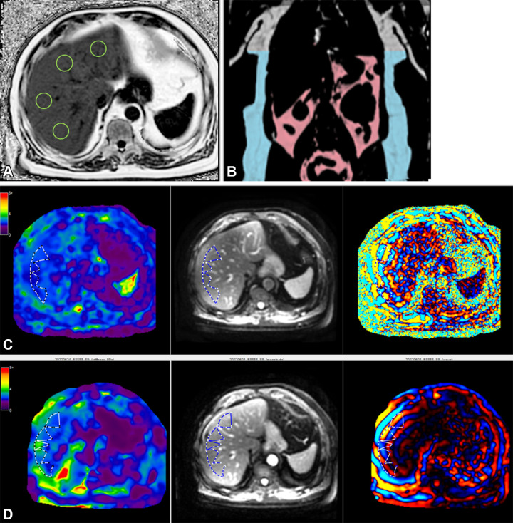 MRI in a 65-year-old male participant with low likelihood of advanced fibrosis according to the fibrosis based on four factors (FIB-4) index. (A) Axial MRI proton density fat fraction map shows regions of interest (green circles) drawn in each Couinaud segment while avoiding any vessels or lesions, as per the study protocol. (B) Coronal image shows body composition with autosegmented visceral (pink) and subcutaneous (blue) adipose tissue. (C) Left to right: Axial elastogram, magnitude, and wave images obtained at two-dimensional MR elastography (MRE) show placement of the region of interest (dotted outline) in the region of parallel wave propagation, avoiding the outer edge of the liver. (D) Left to right: Axial elastogram, magnitude, and wave images obtained at three-dimensional MRE similarly show the region of interest (dotted outline) in a region of parallel wave propagation, avoiding the outer margin of the liver. Color bars alongside elastograms indicate a range of kilopascals from low (purple) to high (red).