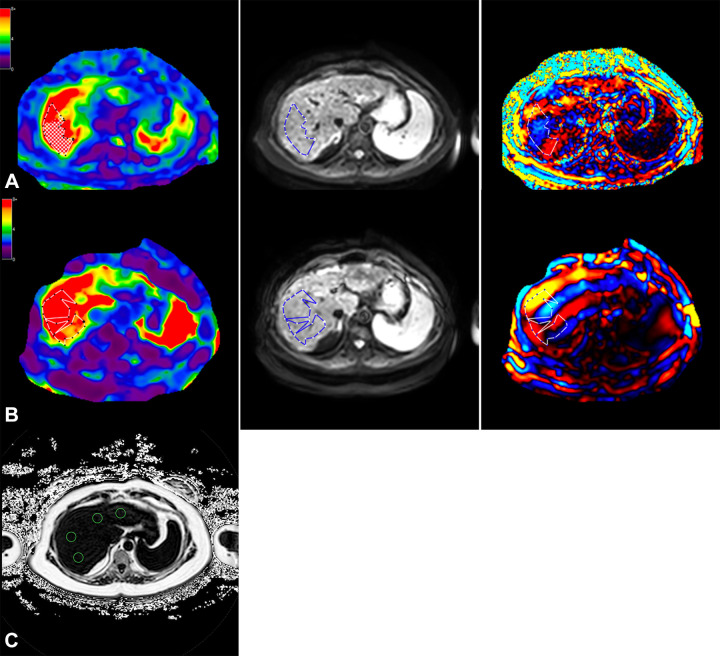 Axial MRI in a 57-year-old female participant with a high likelihood of advanced fibrosis according to the fibrosis based on four factors (FIB-4) index. (A) Left to right: Elastogram, magnitude, and wave images obtained at three-dimensional MR elastography (MRE) show the region of interest (dotted outline) in a region of parallel wave propagation, avoiding the outer margin of the liver. (B) Left to right: Elastogram, magnitude, and wave images obtained at two-dimensional MRE show placement of the region of interest (dotted outline) in the region of parallel wave propagation, avoiding the outer edge of the liver. (C) MRI proton density fat fraction map shows placement of regions of interest (green circles) within different segments of the liver. Color bars alongside elastograms indicate a range of kilopascals from low (purple) to high (red).