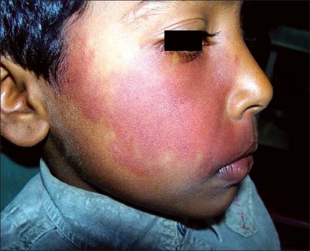 Capillary hemangioma or pyogenic granuloma: A diagnostic dilemma - PMC