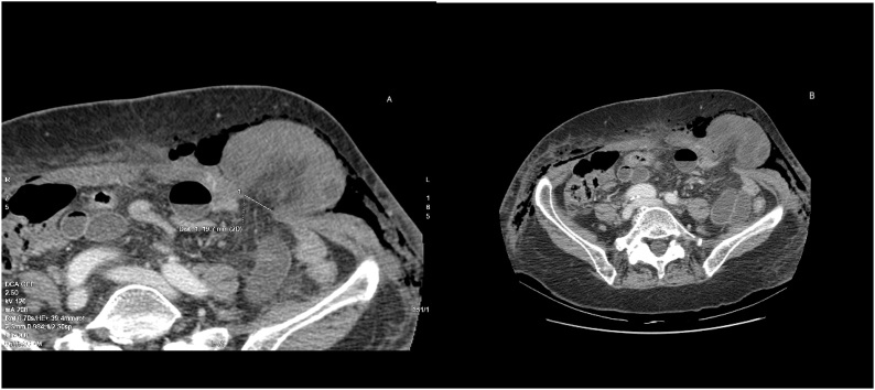 Severe bowel incarceration in an eight-millimeter left-lateral trocar ...