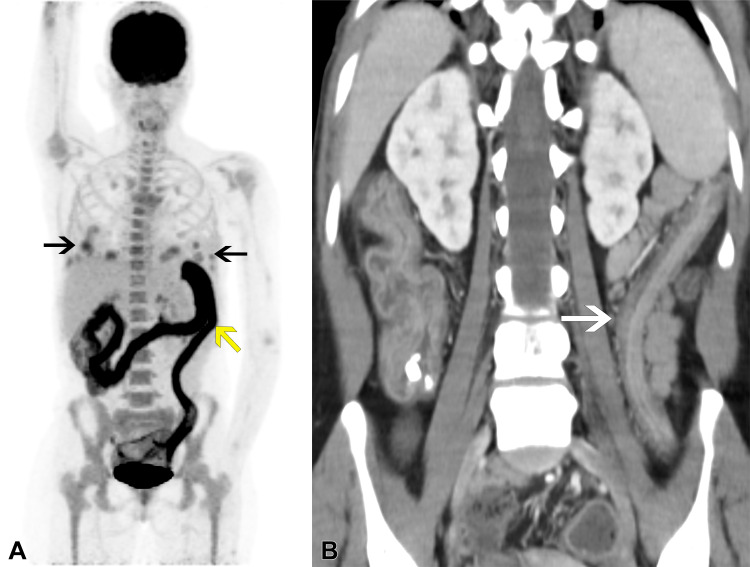 Follow-up imaging in the same patient after tacrolimus withdrawal and initiation of rituximab induction therapy. Despite initial improvement, the patient presented with fever, abdominal pain, and bloody diarrhea after 2 months, before starting chemotherapy. (A) PET/CT image reveals improved uptake levels of the pulmonary masses (black arrows), but intense, diffuse, pancolonic fluorodeoxyglucose uptake was detected, compatible with active colitis (yellow arrow). (B) Corresponding coronal CT image reveals characteristic “lead-pipe” colon (white arrow), indicating clinical suspicion of ulcerative colitis exacerbation secondary to rituximab. Laboratory test results ruled out infection. Low-dose corticosteroid treatment was started with immediate clinical improvement.