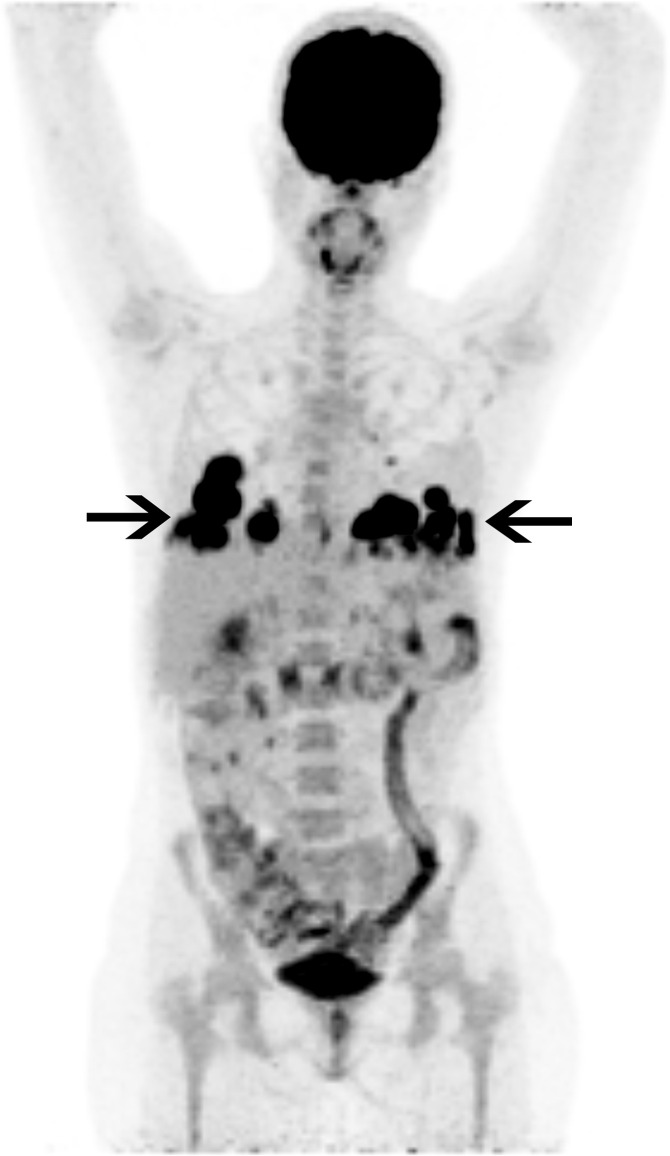 Fluorodeoxyglucose (FDG) PET/CT image in a 27-year-old woman with ulcerative colitis and sclerosing cholangitis who presented with fever and fatigue. She underwent liver transplantation 3 years prior and was receiving immunosuppressive treatment with tacrolimus. Her chest radiograph (not shown) showed basilar pulmonary masses, which were FDG avid on PET/CT image (black arrows). Histologic confirmation following a CT-guided core biopsy indicated pulmonary posttransplant lymphoproliferative disease.