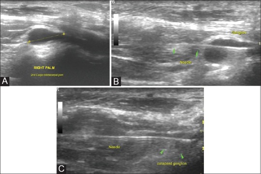 Perspectives in ultrasound-guided musculoskeletal interventions - PMC