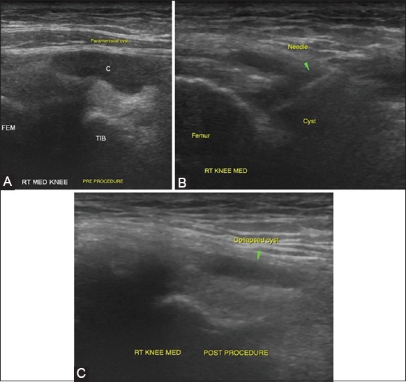 Perspectives in ultrasound-guided musculoskeletal interventions - PMC