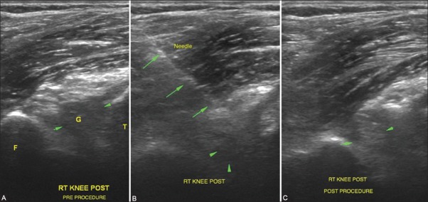 Perspectives in ultrasound-guided musculoskeletal interventions - PMC