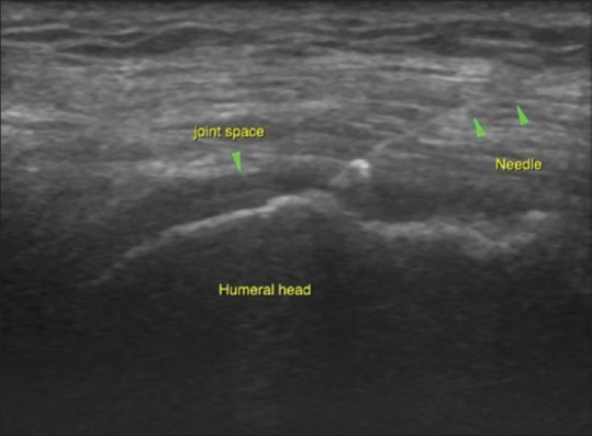 Perspectives in ultrasound-guided musculoskeletal interventions - PMC