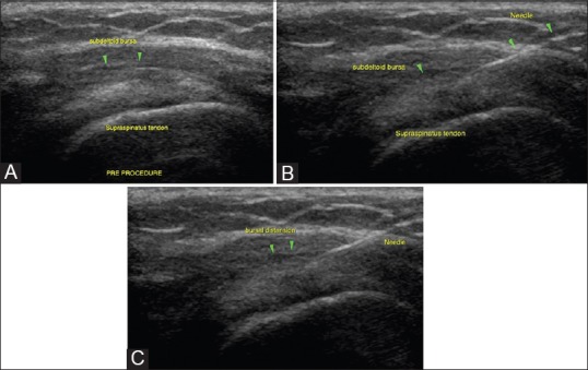 Perspectives in ultrasound-guided musculoskeletal interventions - PMC