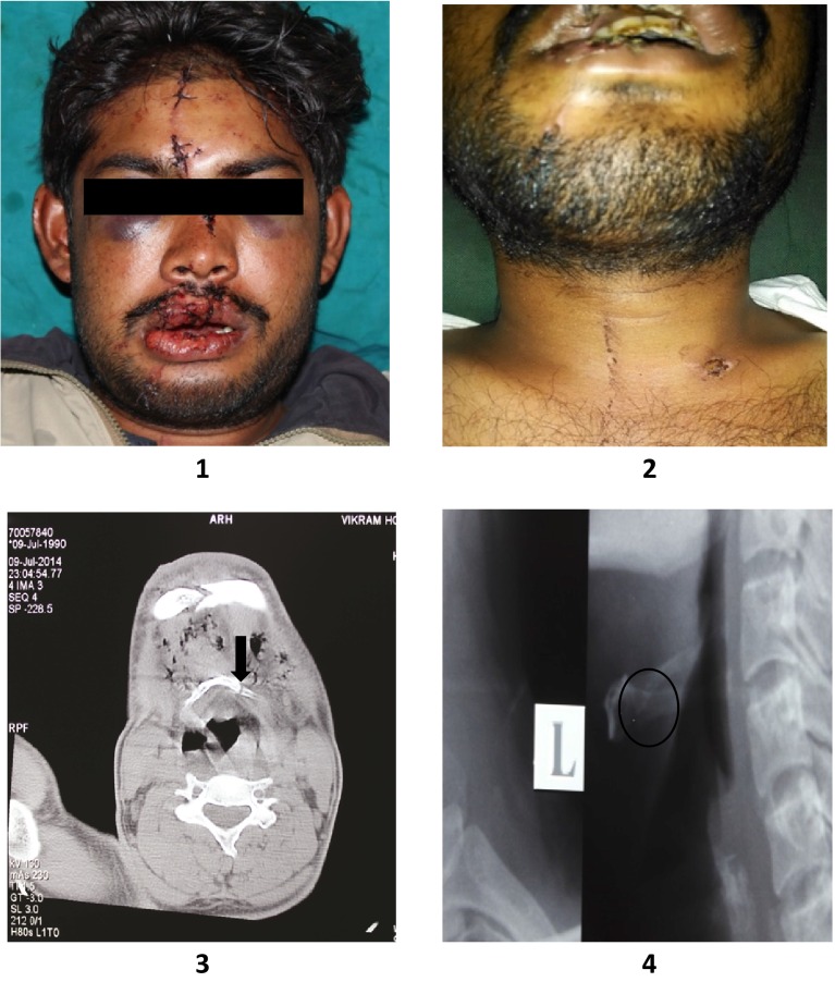 Figs. 1–4