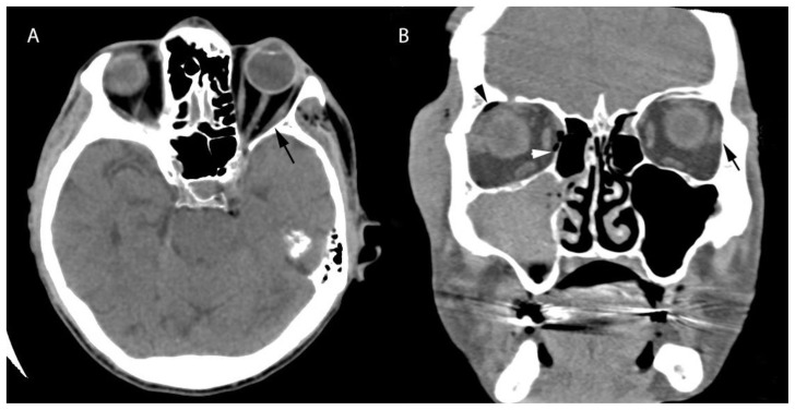 Subperiosteal Hematoma of the Orbit: A Variety of Presentations - PMC