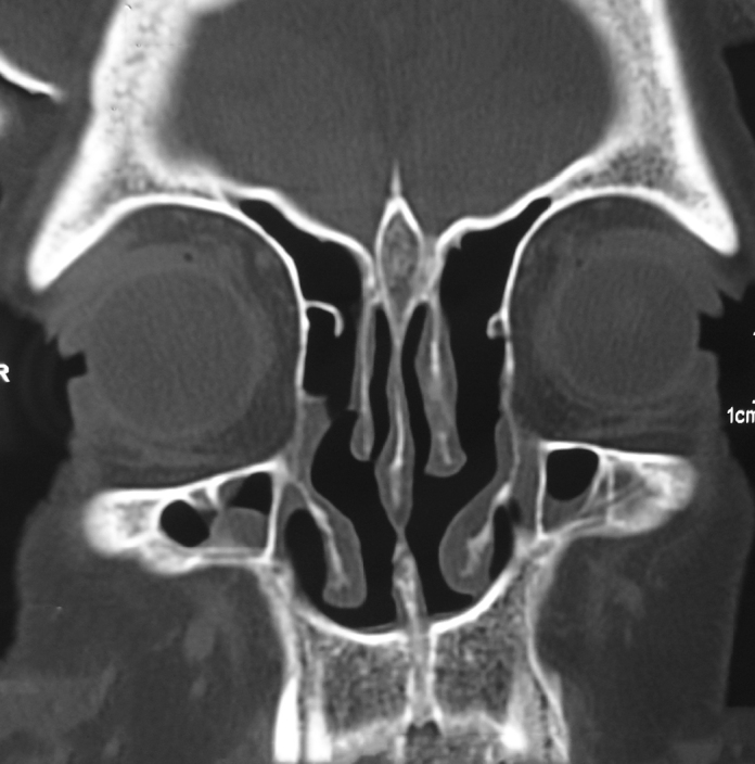 The Analysis of Patients Operated for Frontal Sinus Osteomas - PMC