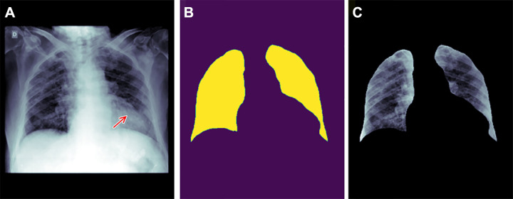 Example of how improper feature removal from imaging data may lead to bias. (A) Chest radiograph in a male patient with pneumonia. (B) Segmentation mask for the lung, generated using a deep learning model. (C) Chest radiograph is cropped based on the segmentation mask. If the cropped chest radiograph is fed to a subsequent classifier for detecting consolidations, the consolidation that is located behind the heart will be missed (arrow, A). This occurs because primary feature removal using the segmentation model was not valid and unnecessarily removed the portion of the lung located behind the heart.