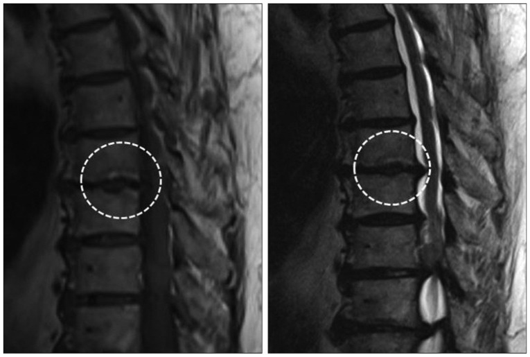 Modic Degenerative Marrow Changes in the Thoracic Spine : A Single ...