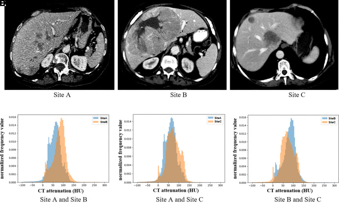 (A–C) Example axial CT images of liver tumors at different sites, and (D–F) histograms show differences in CT attenuation distribution across the three sites.