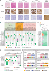 Figure 2. CCA_PDXs maintain the histologic and genomic features of the original biopsy specimens. A, Comparative histologic and IHC images of tumors of CCA_PDXs compared with each original biopsy specimen. Top row, H&E staining; middle row, IHC staining of KRT19 (CCA marker); and bottom row, IHC staining of HepPar1 (HCC). Representative examples of 19 CCA_PDXs are shown; an HCC biopsy sample was used as a control. CCA_PDX samples were collected at passage 1 (PDX133) or passage 2 (PDX78 and PDX119). Scale bar, 250 μm. B, Comparison of somatic mutations identified in CCA_PDXs tumors and their parental biopsy specimens. Genes harboring mutations were classified into three categories: epigenetic regulation, DNA damage response/cell-cycle control, and signaling pathways. CCA_PDX samples were collected at passage 1 (PDX41, PDX123, PDX96, PDX118, and PDX133) or passage 2 (PDX58, PDX62, PDX68.2, PDX78, PDX85, PDX67, PDX75, PDX75.2, PDX119, and PDX120). C, Frequencies of mutations identified as biopsy-specific, PDX-specific, or common somatic mutations. D, Comparison of CNVs identified in CCA_PDXs tumors and the original biopsy samples. E, Diagrams of FGFR2 gene fusions identified in four paired biopsy–PDX samples. Fusion mRNAs (including FGFR2) and their fusion partners are indicated, as well as the predicted protein products of the fusions with their functional domains. Numbers represent the exon of the corresponding genes.