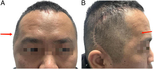 Clinical Outcomes After Cranioplasty With Titanium Mesh ...