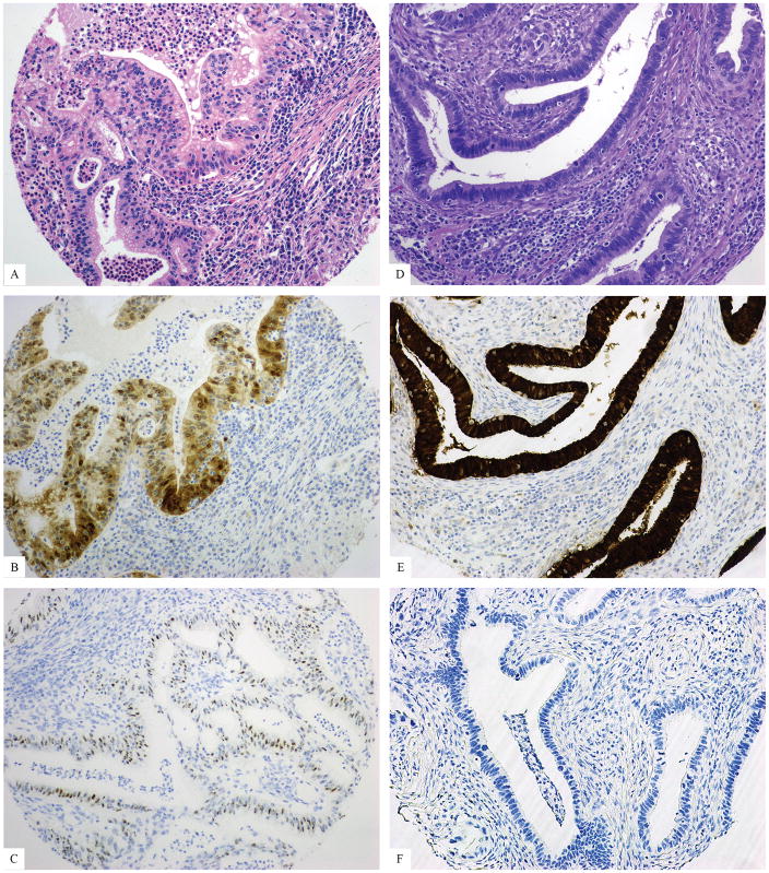 International Endocervical Adenocarcinoma Criteria And Classification Iecc A New Pathogenetic 1822