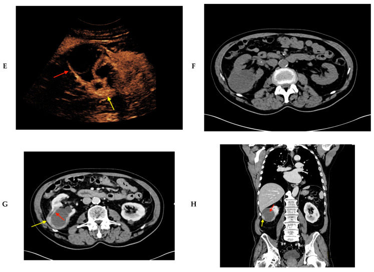 Contrast-Enhanced Ultrasound (CEUS) for Follow-Up of Bosniak 2F Complex ...