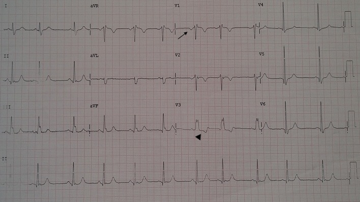 Wellens’ syndrome: a pattern to remember - PMC