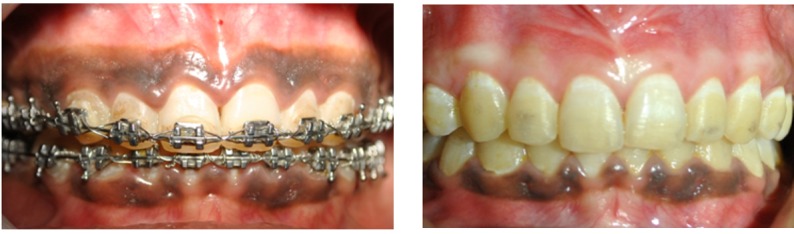 Fig. 1: Case 1 Pre and Post Operative Views