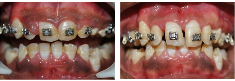 Fig. 2: Case 2 Pre and Post Operative Views