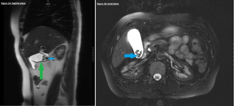 hemolytic-anemia-sneaky-cause-leaky-valve-pmc