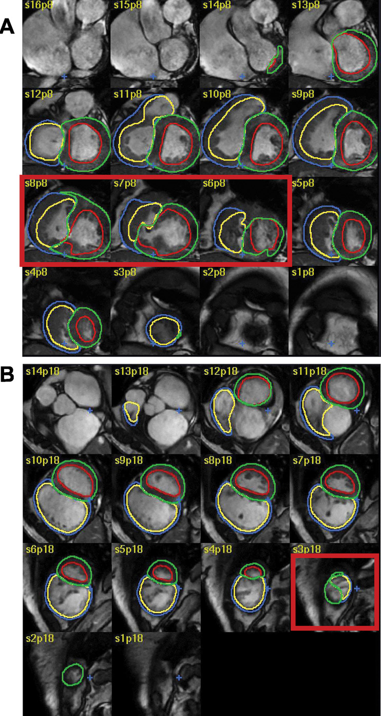 Examples of failed and suboptimal artificial intelligence (AI) segmentations. (A) Major failure because of congenital heart disease causing the left ventricular (LV) contours to extend into the right ventricle (RV; red box). (B) Minor failure at the apex where the RV was incorrectly labelled as LV (red box). The red, green, blue, and yellow circles indicate the LV endocardial, LV epicardial, RV endocardial, and RV epicardial contors, respectively.