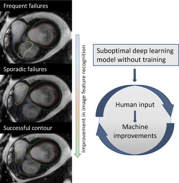 Example of improvement following additional training. This example demonstrates improvement of the right ventricular base after additional training. The first model missed the right ventricular outflow tract and included the right atrium instead (top image: yellow annotation showing right ventricular endocardial border), whereas the final model correctly included the right ventricular outflow tract and excluded the right atrium (bottom image).