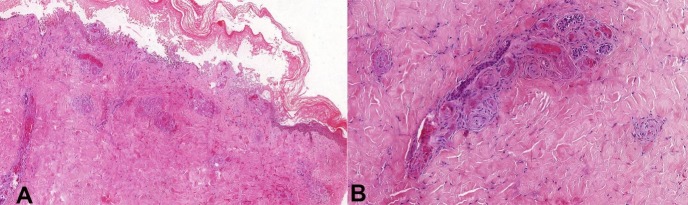 Livedoid vasculopathy: a compelling diagnosis - PMC