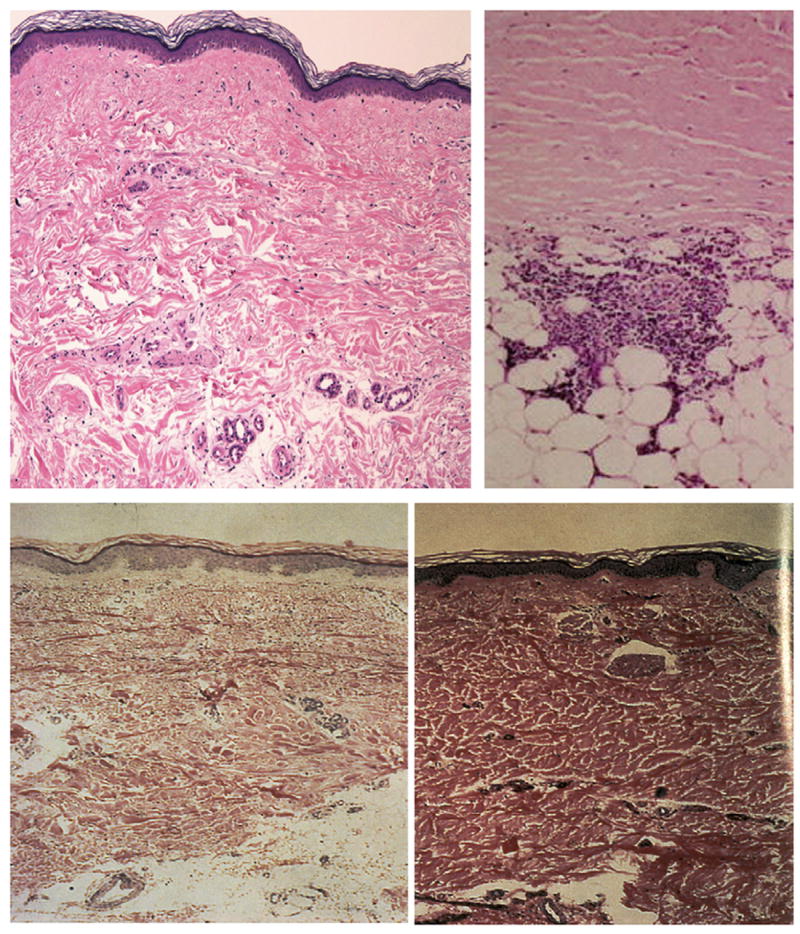 Fibrosis in Systemic Sclerosis - PMC