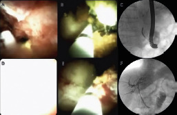 Photodynamic therapy (PDT) of an extrahepatic cholangiocarcinoma
using a digital cholangioscopy to deliver the laser