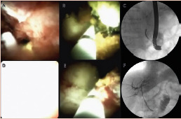 Terapia fotodinâmica (TFD) de colangiocarcinoma extra-hepático
utilizando colangioscopia digital para fornecer o laser