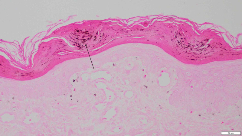 Clinical, Dermatoscopic, and Histological Findings in a Diagnosis of ...