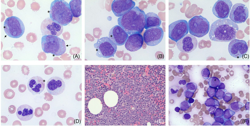 The presence of Auer rods in neutrophils and monocytes besides blasts ...