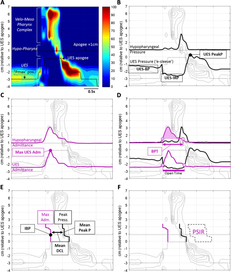 Diagnosis of Swallowing Disorders: How We Interpret Pharyngeal ...