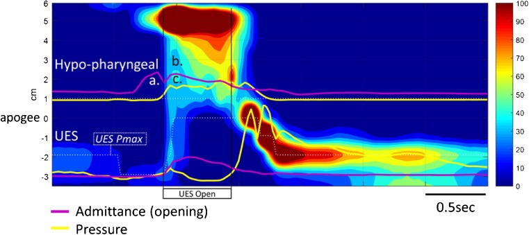 Diagnosis of Swallowing Disorders: How We Interpret Pharyngeal ...