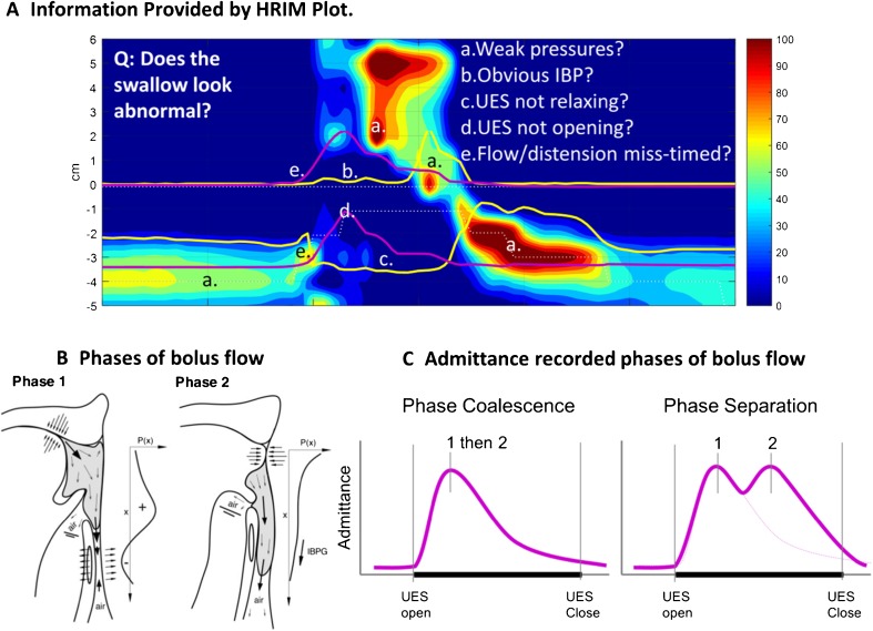 Diagnosis of Swallowing Disorders: How We Interpret Pharyngeal ...