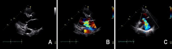 Cox-Maze III procedure with valvular surgery in an autopneumonectomized ...