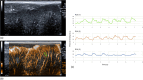 An example of some of the information that could be available with ultrasound imaging methods if it were not for the aberrating and attenuating effects of the skull, or if eventually full correction for these effects were to become possible.