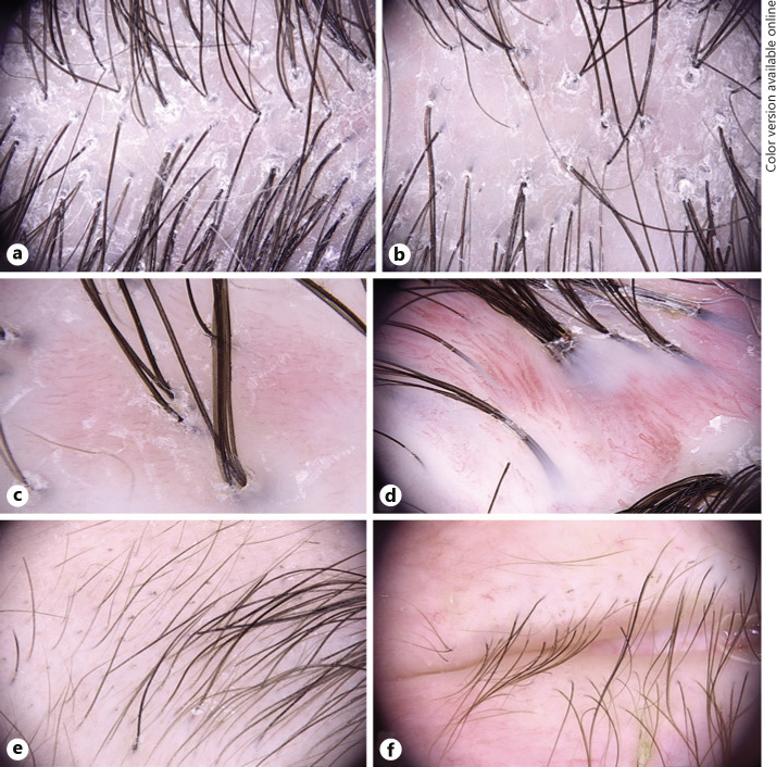 The Role Of Trichoscopy In Keratosis Follicularis Spinulosa Decalvans Case Report And Review Of