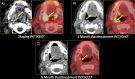 A, T4aN1M0 squamous cell carcinoma of the right palatine tonsil staging PET/contrast-enhanced CT (CECT). Patient was treated with chemoradiation therapy alone. B, At 3 months after treatment, PET/CECT scan demonstrated an enhancing soft-tissue mass along the superior margin of ulceration in the region of palatine tonsil with corresponding intense fluorodeoxyglucose uptake, concerning for residual tumor. However, upon direct visualization, the otolaryngologists suspected the imaging findings were radiation injury to soft tissues. A CT-guided biopsy revealed inflammatory cells and necrotic debris. C, On 6-month follow-up images, there is marked improvement in fluorodeoxyglucose uptake. This case was particularly difficult, with half of our raters assigning a NI-RADS category 2a and the others a 3, and became an index case to help define the 2a category. Immediate posttreatment PET/CECT scans with mucosal-based abnormalities are now typically assigned a NI-RADS category 2a, as many of these are tumefactive radiation injury.