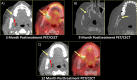 T2N0M0 squamous cell carcinoma of the right buccal mucosa treated with wide local excision, selective neck dissection, and right forearm free flap. A, At 3-month posttreatment contrast material–enhanced CT, there was a linear area of enhancement along the lateral aspect of the right first mandibular molar (yellow arrow). At PET, this area was associated with intense fluorodeoxyglucose uptake (yellow arrow). Of note, the curvilinear enhancing lesion represents the pedicle of the forearm free flap (red arrow). Clinical examination findings were not suggestive of tumor recurrence but felt to represent tumefactive radiation injury. B, A contrast-enhanced neck CT scan with bone window obtained 9 months after treatment demonstrates destructive osseous changes centered around the right maxillary tuberosity and right mandible (yellow arrow). CT-guided biopsy revealed fibrotic tissue with inflammation, consistent with osteoradionecrosis. C, At imaging 12 months after treatment, there is interval improvement in fluorodeoxyglucose uptake (yellow arrow). Half of the raters assigned the first posttreatment study a NI-RADS category 3 at the primary site. However, given its mucosal location for direct clinical examination, NI-RADS 2a is more appropriate. Red arrow indicates curvilinear enhancing lesion representing pedicle of forearm free flap.