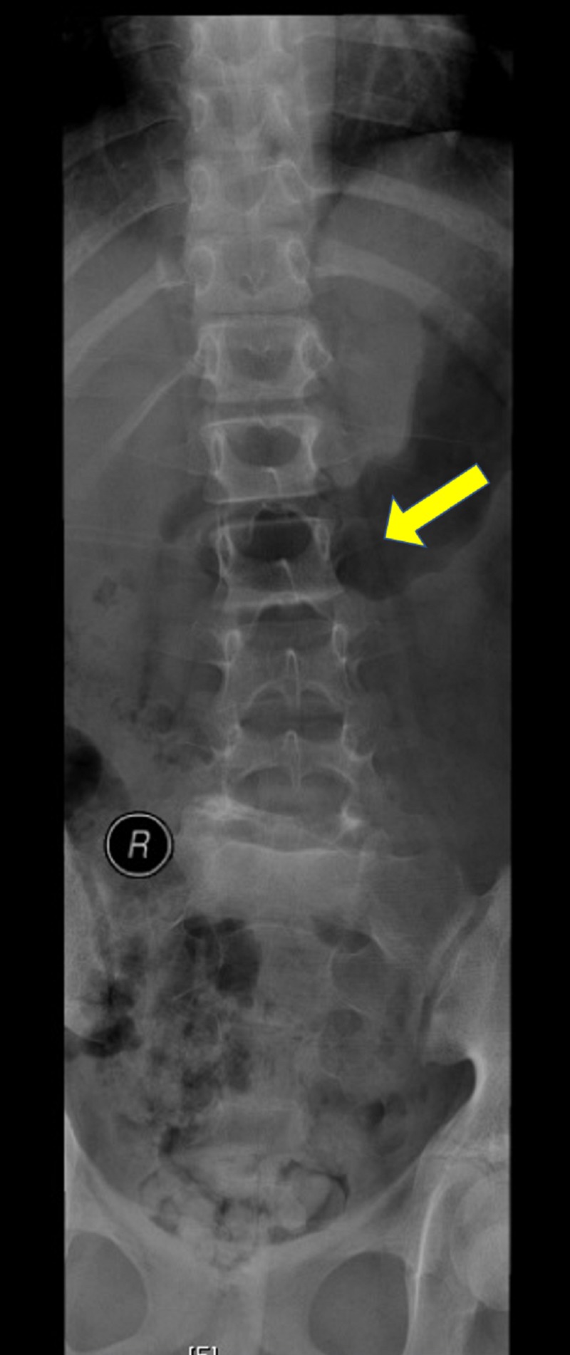 Scoliosis Associated With Lumbar Spondylolisthesis Spontaneous light-cramps-early-pregnancy-decoratingspecial