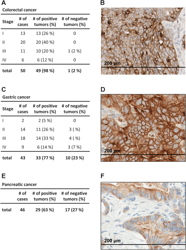 Figure 1. Identification of B7-H6 as antigen in human gastrointestinal tumor tissues. Colorectal cancer (A and B), gastric cancer (C and D), and pancreatic cancer (E and F) tissues containing at least 1% tumor cells with membranous B7-H6 expression. Representative images of colorectal cancer (B), gastric cancer (D), and pancreatic cancer (F) tissue sections. Cells with membranous B7-H6 staining were quantified manually by a trained pathologist.