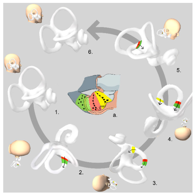 Apogeotropic Horizontal Canal Benign Paroxysmal Positional Vertigo ...