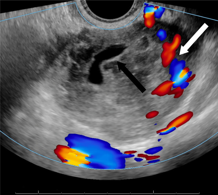 Transvaginal Ultrasound Diagnosis Of Ovarian Ectopic Pregnancy PMC transvaginal-ultrasound-diagnosis-of-ovarian-ectopic-pregnancy-pmc