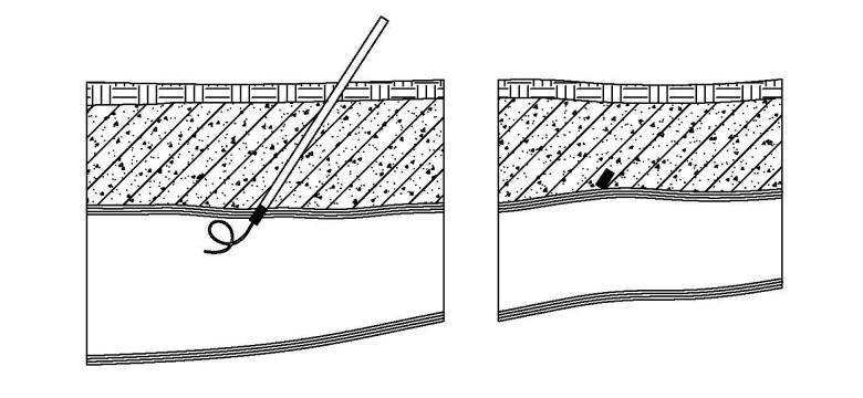 Advancements in Vascular Closure Devices for Effective Hemostasis in ...