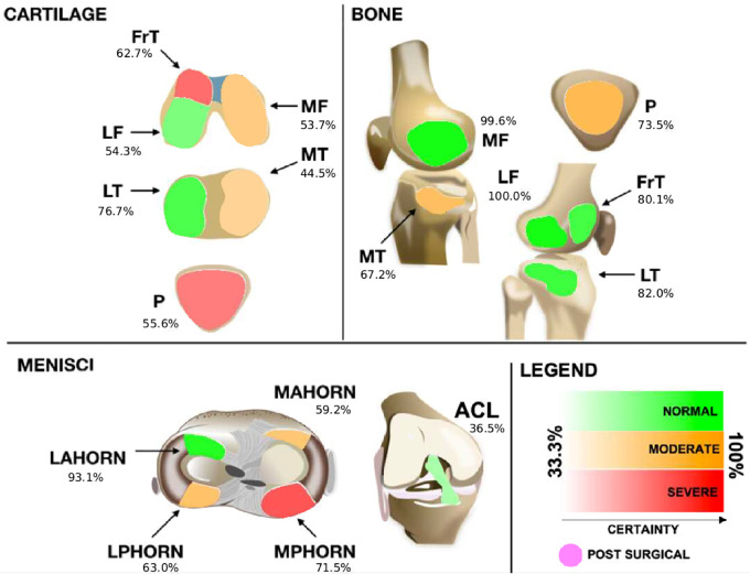 Proposed graphical interface used to inform the radiologists of the models' outputs. Colors indicate the lesion class: red indicates a severe lesion, orange indicates a moderate (or mild) lesion, and green indicates no lesion. Transparency indicates the probability output by the model for that class (ie, stronger colors indicate more confidence). Probabilities range from 33.3% (very uncertain) to up to 100% (most certain) for three classes of every tissue. The anterior cruciate ligament (ACL), when deemed reconstructed, is set to a differentiated color with no transparency level and is indicated as being postsurgical. FrT = trochlea, LAHORN = lateral anterior horn, LF = lateral femur, LPHORN = lateral posterior horn, LT = lateral tibia, MAHORN = medial anterior horn, MF = medial femur, MPHORN = medial posterior horn, MT = medial tibia, P = patella.