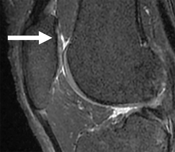 Sagittal sequence of the knee demonstrates a small partial-thickness defect (arrow) at the patellar cartilage (Whole-Organ MRI Score grade 2). The patellar cartilage defect was graded as normal by two trainees but was graded as a partial-thickness lesion by both the attending physicians in the first round of grading. In the second round of grading, the same lesion was recognized with the aid of the model and was graded as a partial-thickness lesion by all four readers.